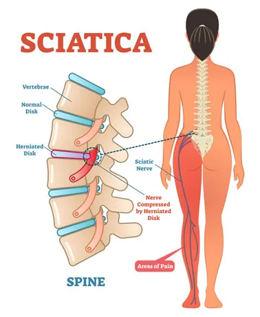 sciatica chiropractor charlotte