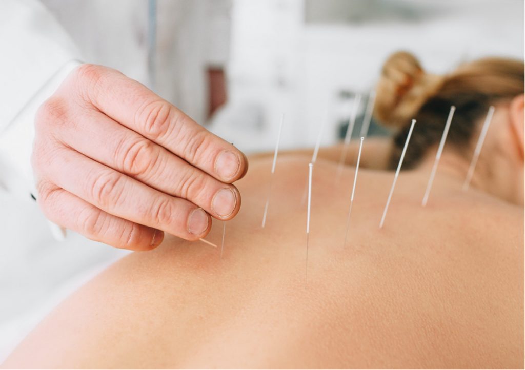 dry needling chiropractor