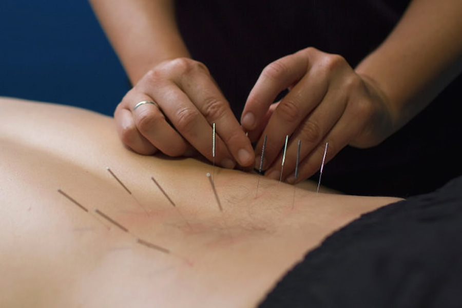 dry needling chiropractor