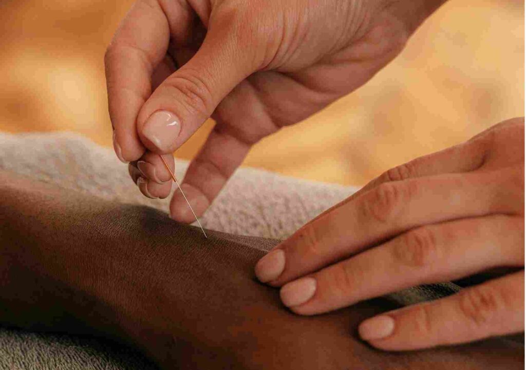 Acupuncture